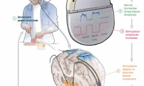 Conférence ‘ Les traitements pour Parkinson de l’ABC à la chirurgie’