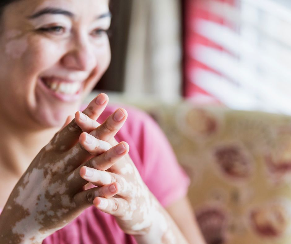 Le vitiligo