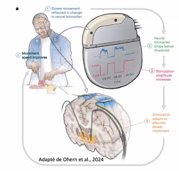 Conférence ‘ Les traitements pour Parkinson de l’ABC à la chirurgie’